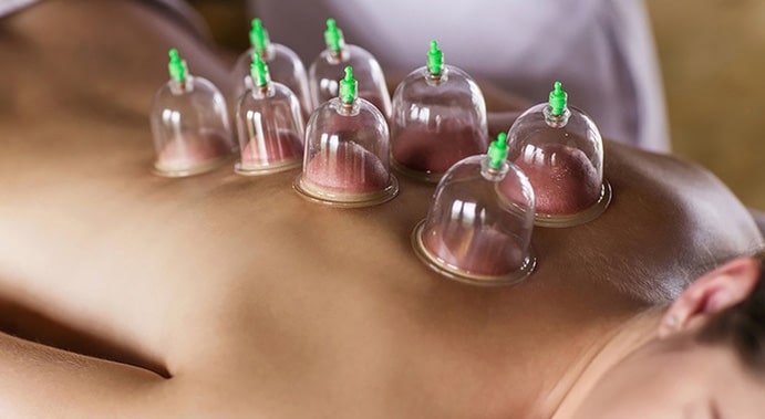 Cupping - Jasperse Praktijkencentrum