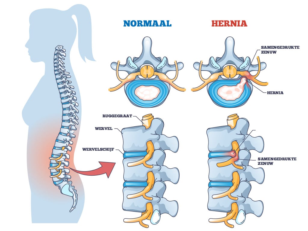 Hoe behandel je een hernia zonder operatie