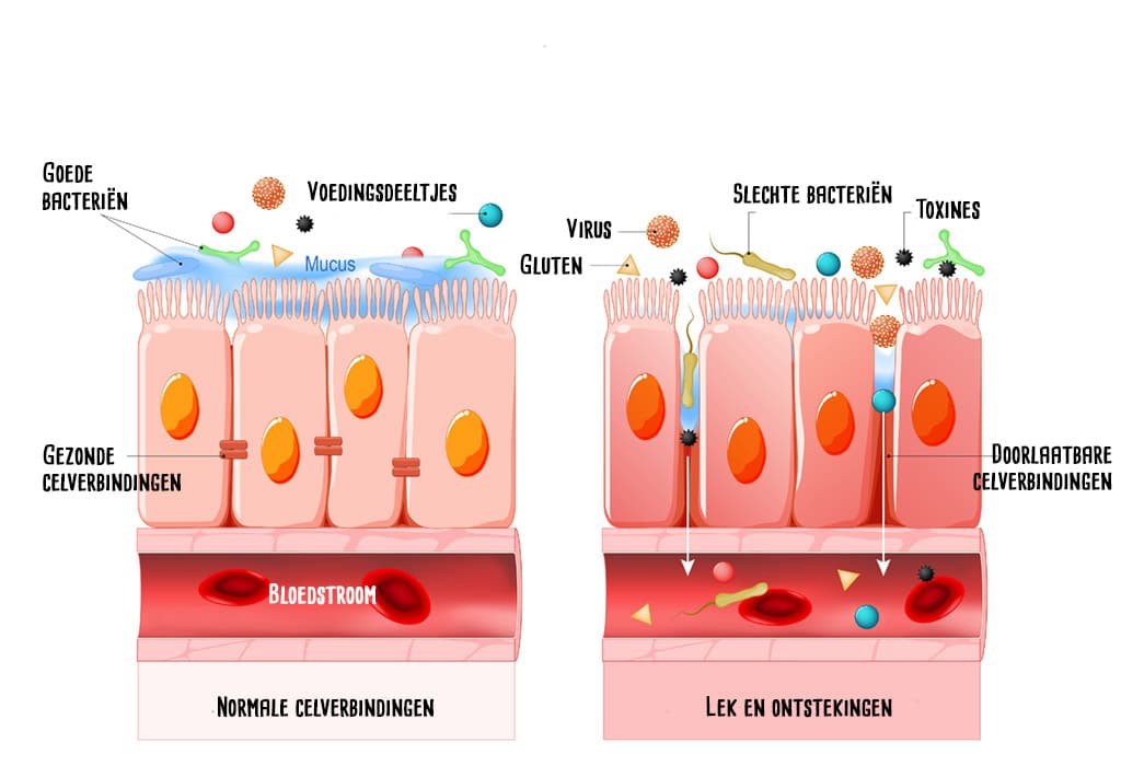 Het Leaky Gut syndroom 4 leaky gut syndroom 2