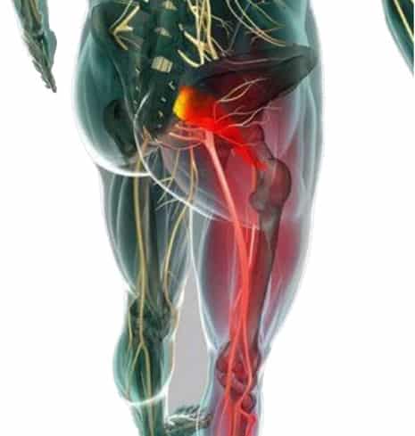Het Piriformis-syndroom 4 pirriformis 1