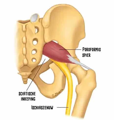 Het Piriformis-syndroom 5 pirriformis 2