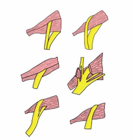 Het Piriformis-syndroom 6 pirriformis 3
